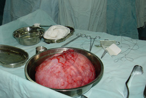 手术切除2.5公斤子宫肌瘤